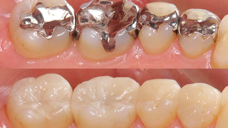 銀歯は体に悪い影響を与えることもあります