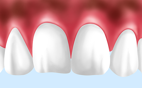 歯ぐきの黒ずみを健康的なピンク色にします