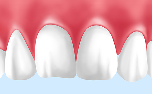 歯ぐきの黒ずみを健康的なピンク色にします