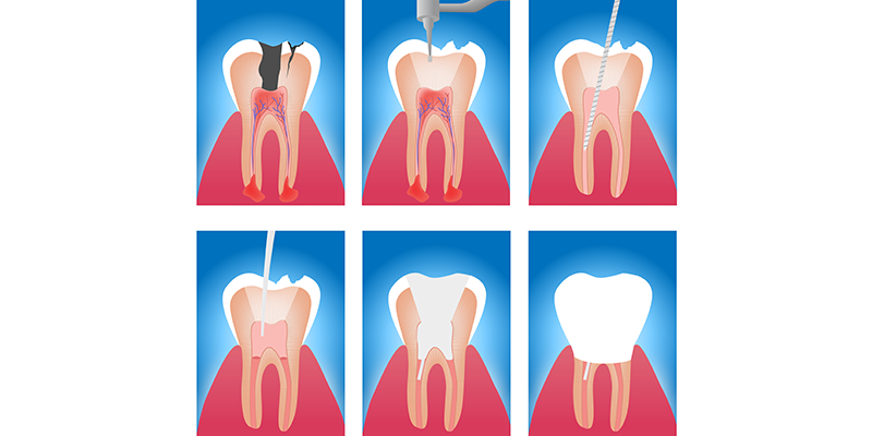 重度の虫歯は「根管治療」します
