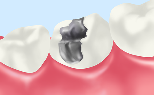 メタルインレー（金属の詰め物）