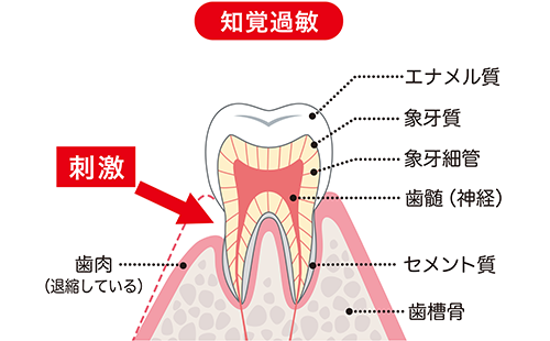 知覚過敏をご存知ですか？