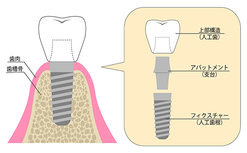 インプラント治療とは
