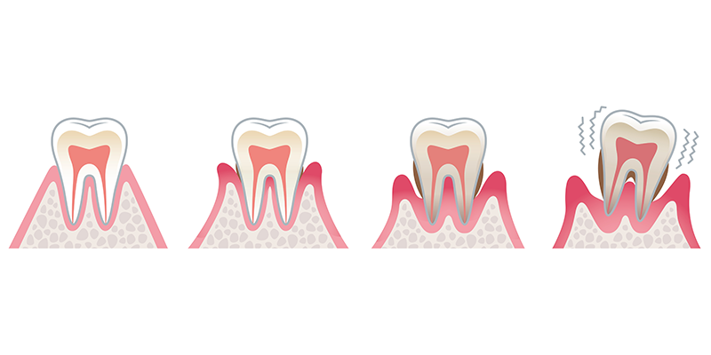 歯周病とはどんな病気なのでしょうか？