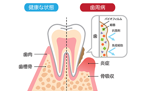 プラーク……それは細菌の巣です