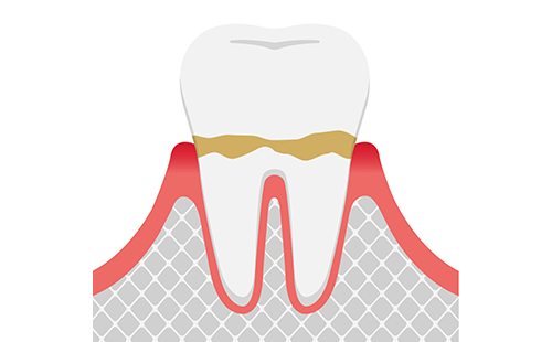軽度歯周炎