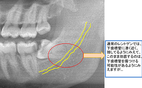 当院では歯科用CTを活用しています