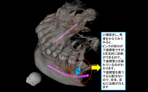 当院では歯科用CTを活用しています