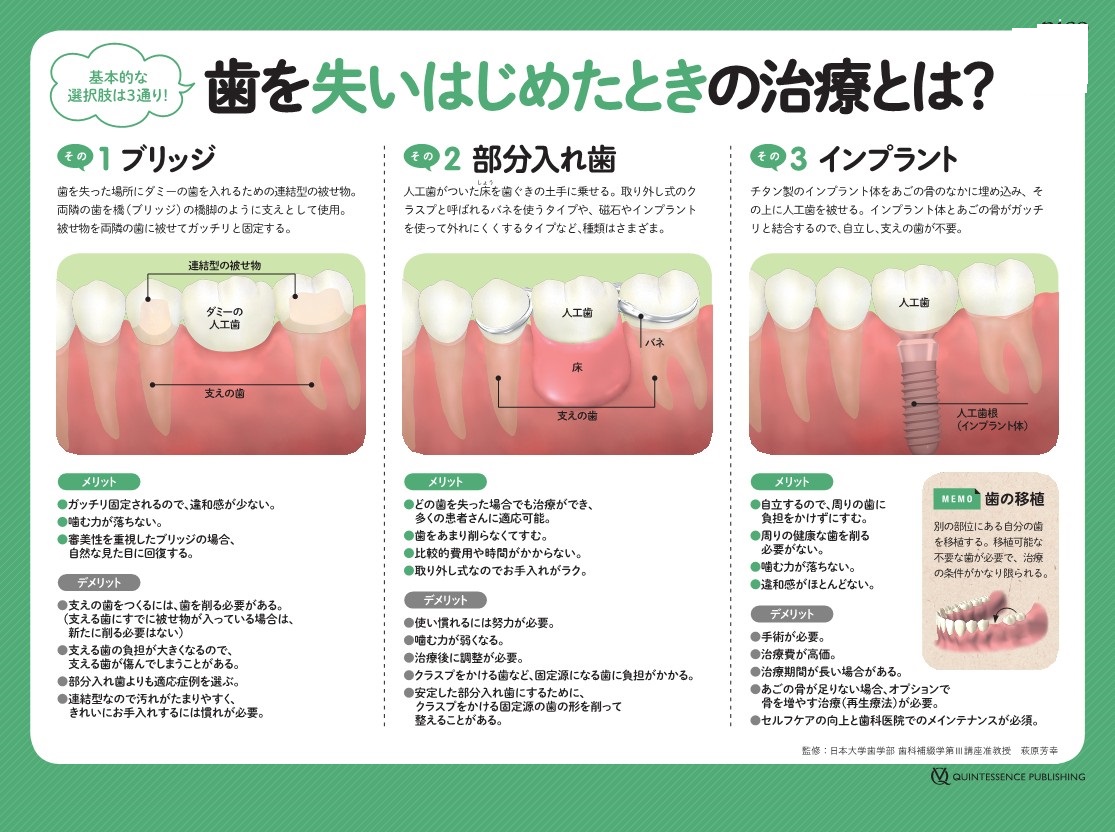 歯を失った場所の治療は？