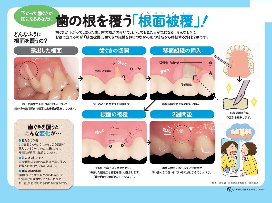 歯の根を覆う根面被覆とは？