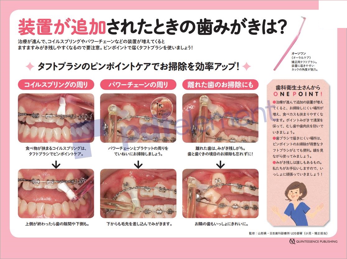 矯正装置が追加された時の歯磨きは？