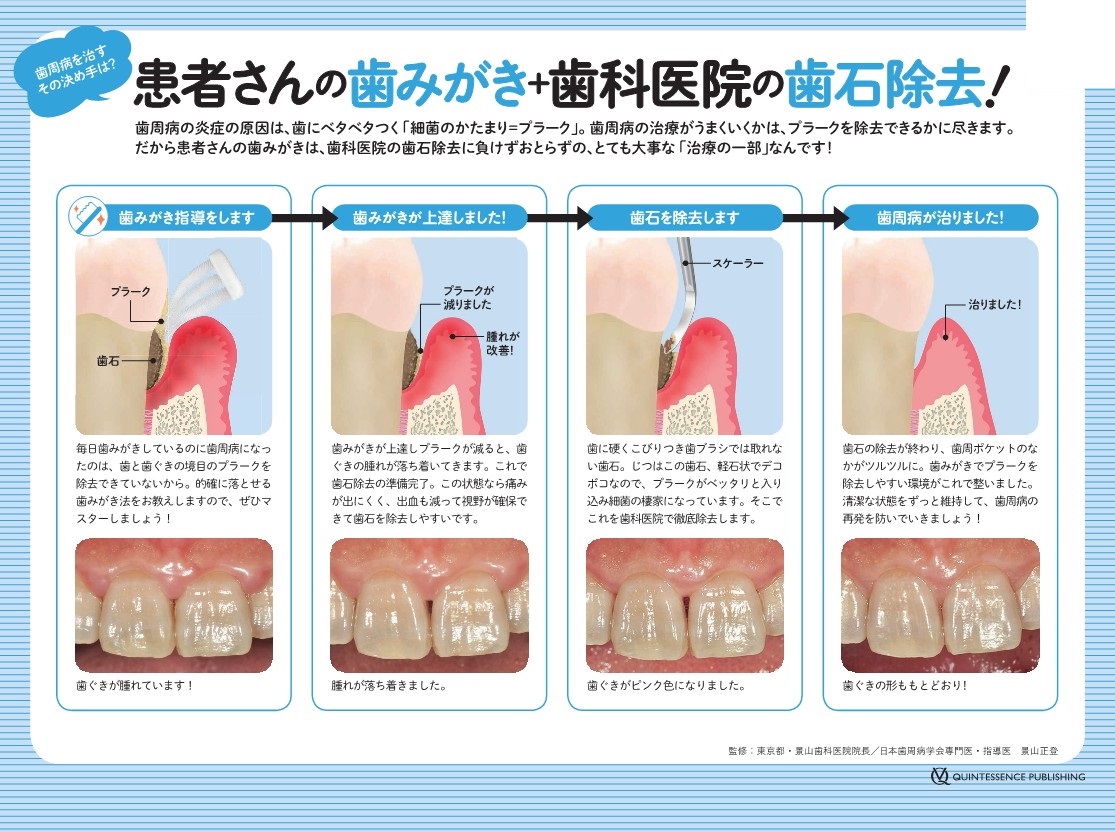 歯周病とは？