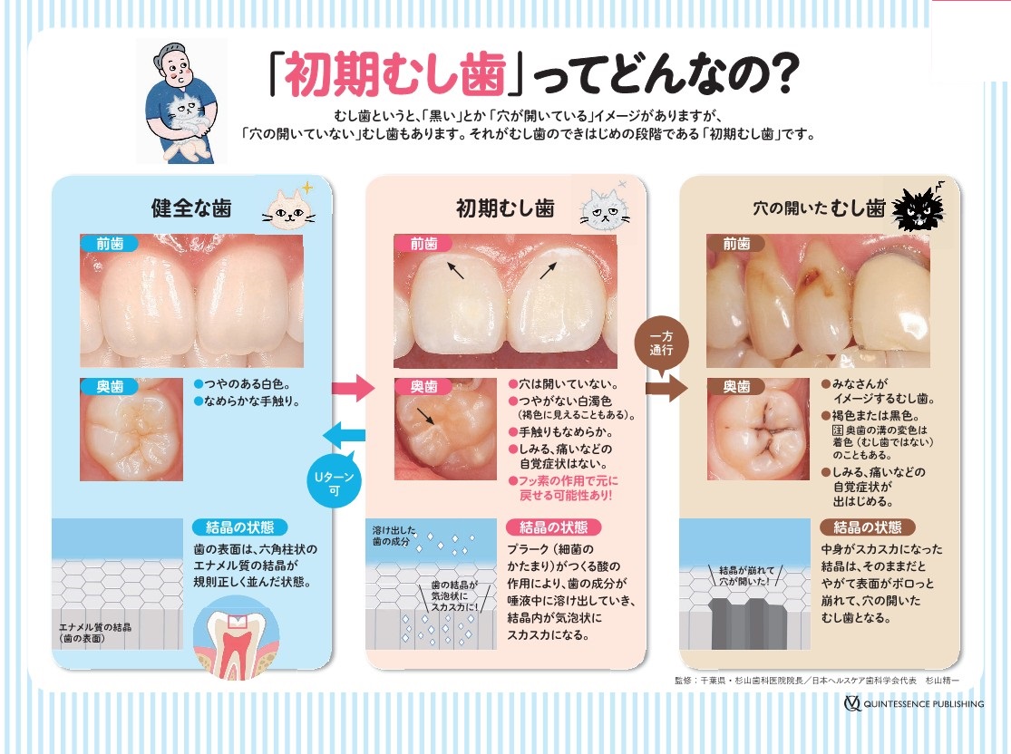 初期虫歯ってどんなの？