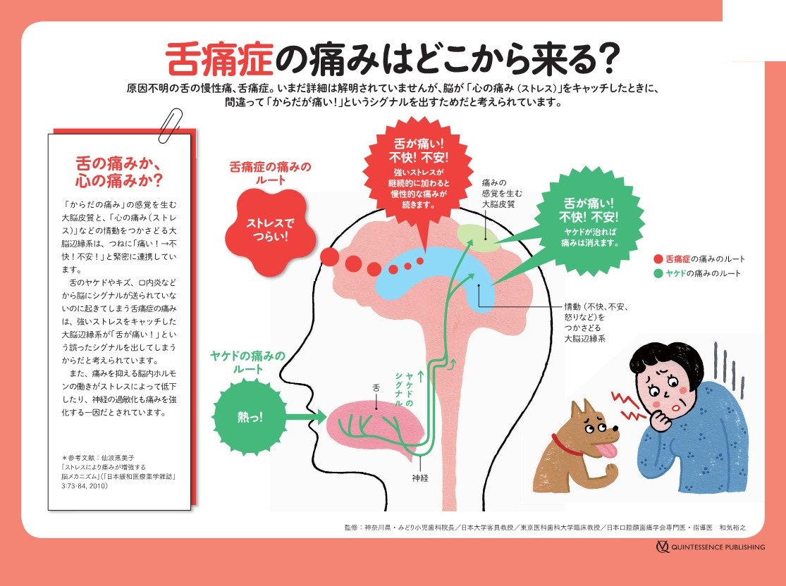 舌痛症とは？