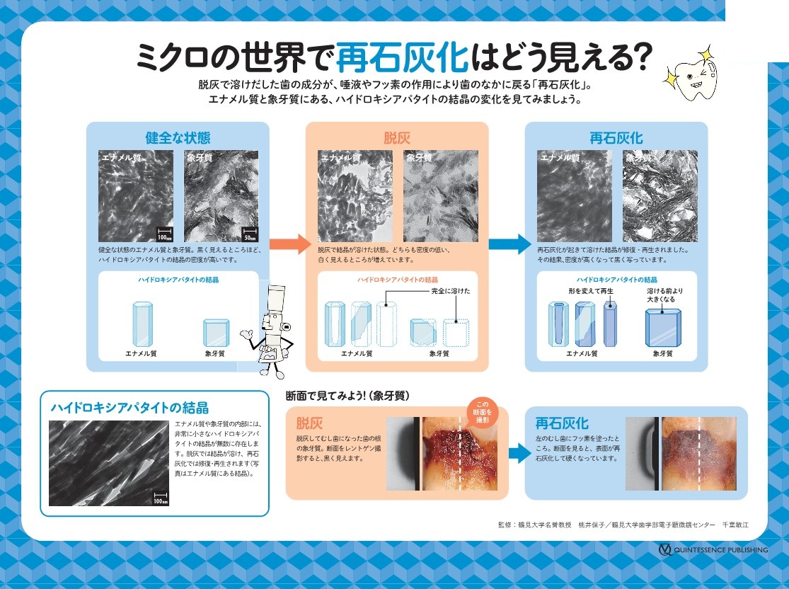 脱灰と再石灰化