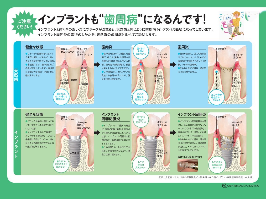 インプラントも歯周病になります