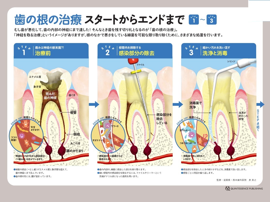歯の根の治療について