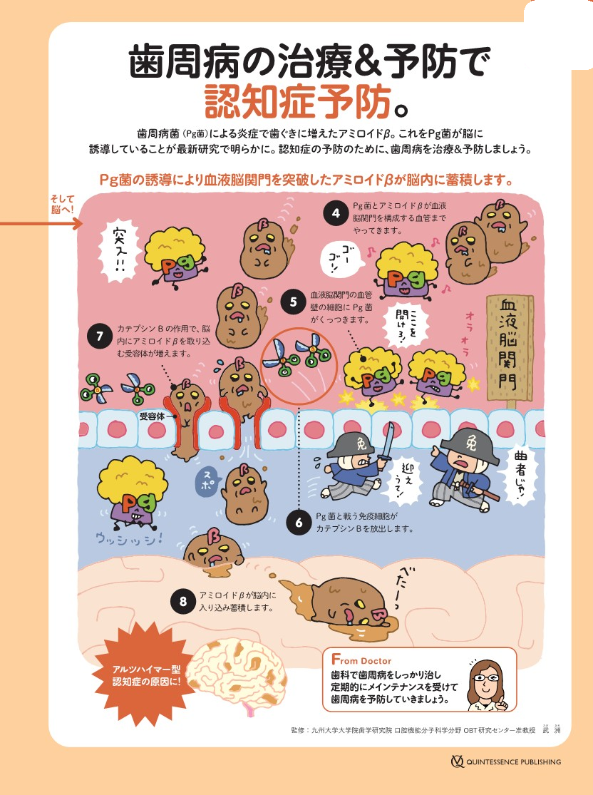 歯周病が認知症の原因に